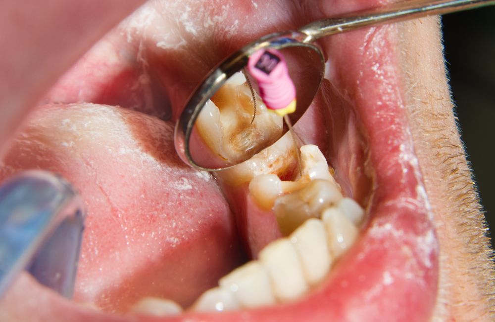 Site Urgências Dentárias 24 Horas_Imagens Especialidades_Endodontia