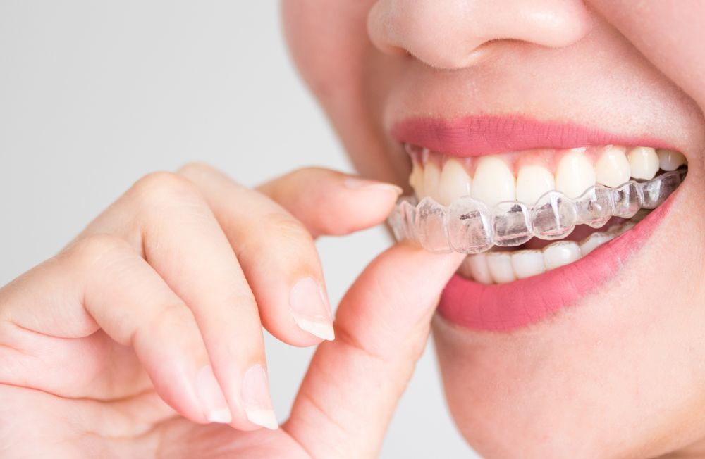 Site Urgências Dentárias 24 Horas_Imagens Especialidades_Invisalign