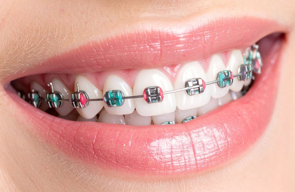 Site Urgências Dentárias 24 Horas_Imagens Especialidades_Ortodontia